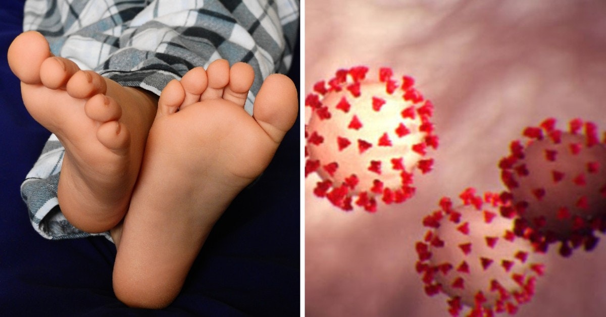 Doctors Say "COVID Toes" Might Be An Early Sign Of Coronavirus