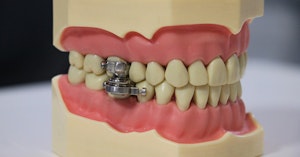 Dental model of human teeth with metal device attached to top and bottom molars
